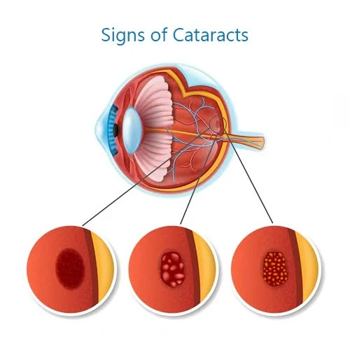 eye-doctor-in-lucknow